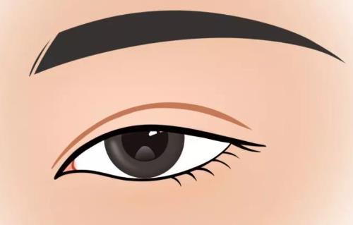 双眼皮手术的恢复期要多久？恢复期间需要注意哪些事情？