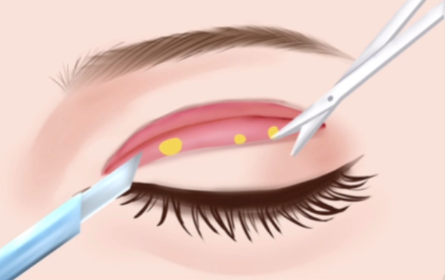 埋线双眼皮让你拥有迷人大眼睛!效果能维持多久?