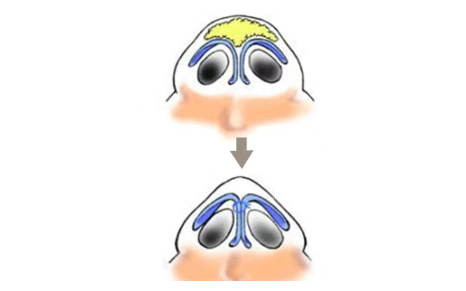 常见的鼻子缩小方法有哪些?