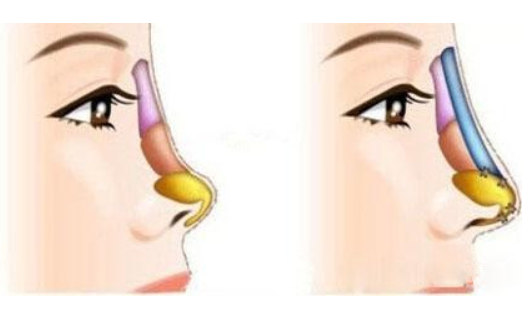 鼻整形选哪种假体更合适?