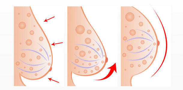 乳房下垂悬吊术：费用、手术过程与潜在后遗症全解析