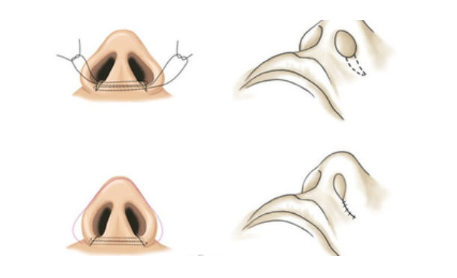 鼻翼内切与切鼻基底：两者间的微妙差异