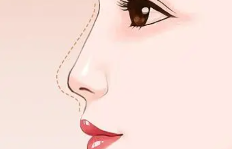 精细化鼻部整形：美鼻需要具备的要素解析