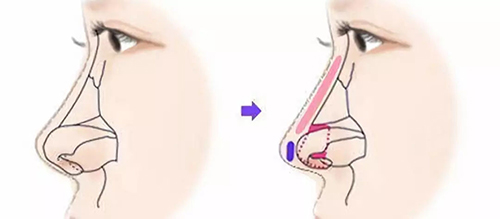 肋骨鼻修复原来鼻子中的肋骨可以二次用吗?