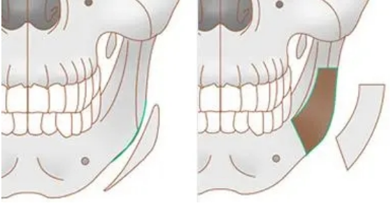 如何有效瘦下颌角?最新医美手术方法揭秘