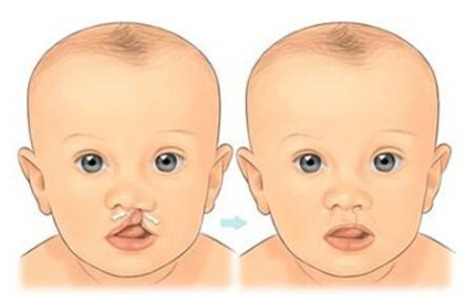 双侧唇裂修复最佳时机：科学决策，为孩子带来最佳治疗效果