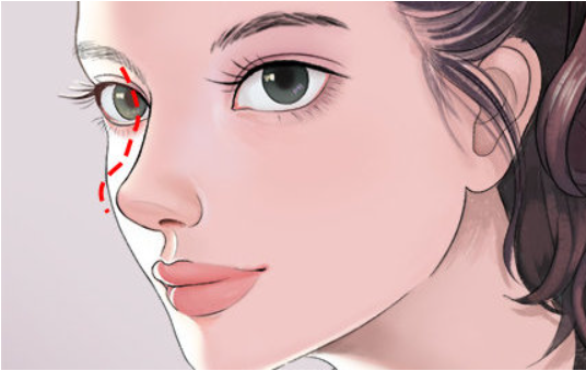 详解硅胶隆鼻与膨体隆鼻材料区别