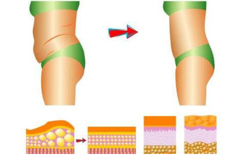 吸脂手术后多久能看到明显效果?