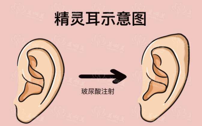 精灵耳整形：玻尿酸注射与假体植入的比较