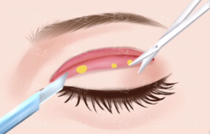 埋线双眼皮失败的症状探讨