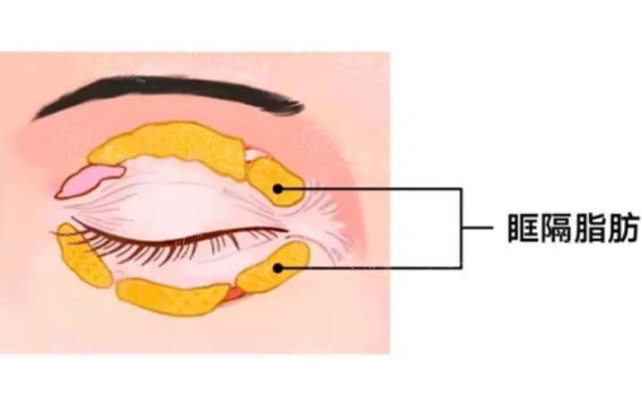 双眼皮吸脂手术的适宜人群有哪些？