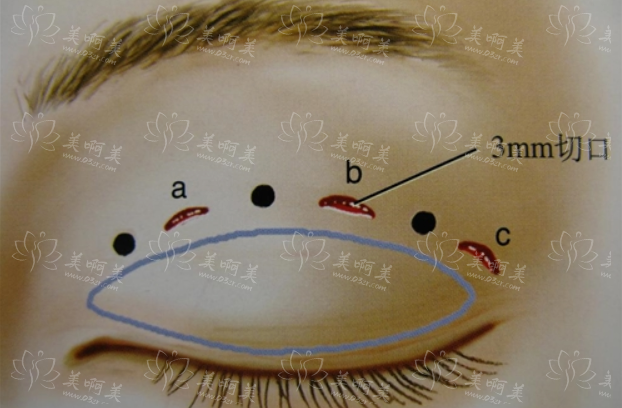双眼皮三点式：了解特点与优势