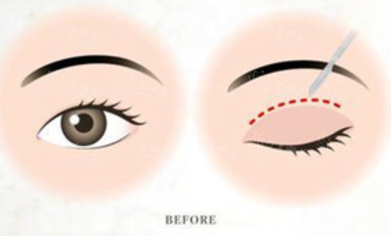 切开双眼皮手术后恢复时间探析