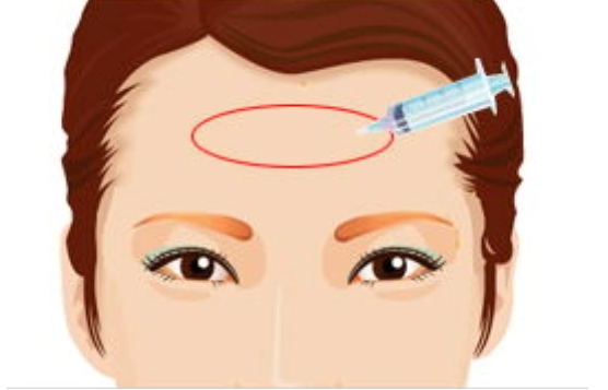 额头填充：哪种玻尿酸更适合？