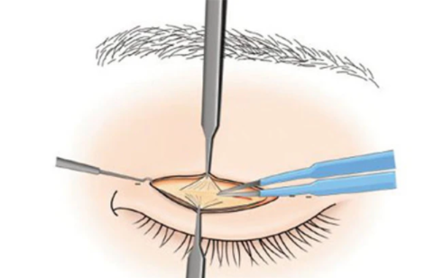 双眼皮手术是否会留下明显的疤痕? 双眼皮手术是否会留下明显的疤痕?
