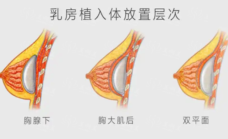 假体隆胸会随着时间的推移变得越来越硬吗？