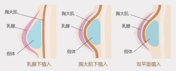 隆胸假体手术后：恢复之路与时间探索