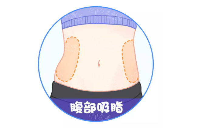 吸脂手术与假体隆胸手术：哪种手术疼痛感更强烈？
