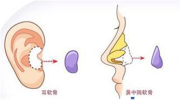 耳软骨隆鼻的取出方法