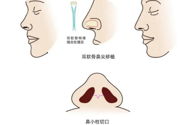 耳软骨隆鼻后多久会变得柔软？