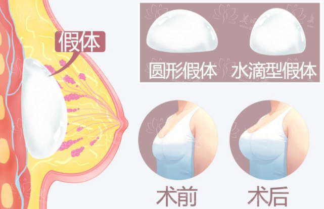 隆胸手术中使用的硅胶材料解析