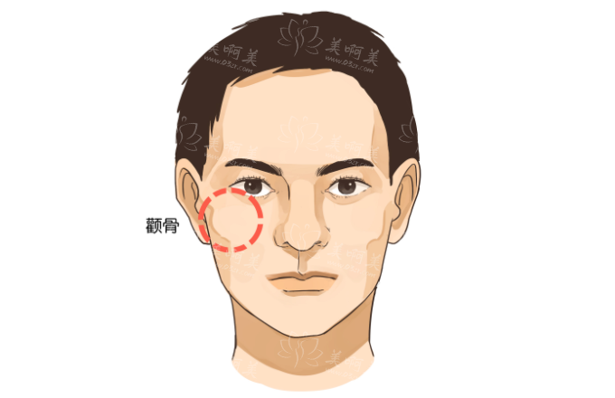 颧骨内推：塑造理想脸型的医美手术