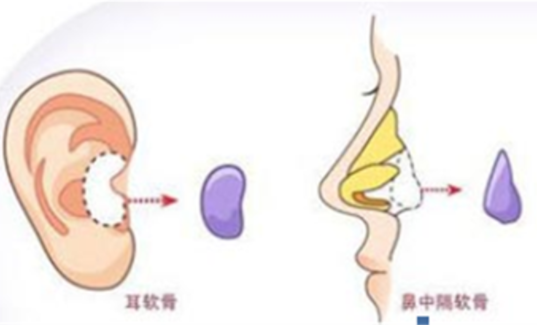 耳软骨隆鼻手术后的自然恢复期探索