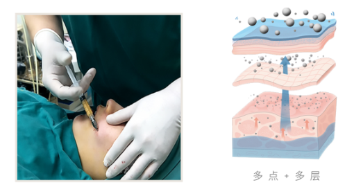 广州艺星邓晟华吸脂靠谱吗?技术特色解析一览 广州艺星邓晟华吸脂靠谱吗?技术特色解析一览