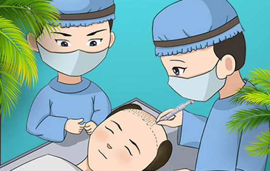 了解毛发种植的恢复周期和结果时间
