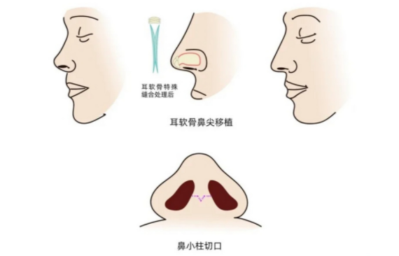 软耳骨隆鼻手术后需要多长时间才能恢复?