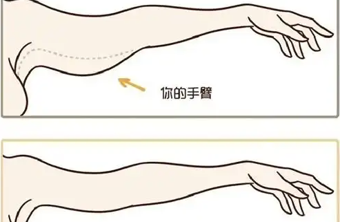 手臂吸脂手术的结果究竟如何?