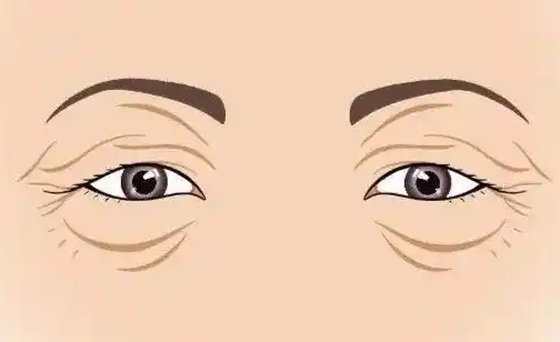 了解双眼皮下垂的原因与解决方法