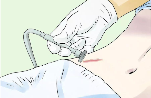 去除疤痕的有效方法有哪些？如何选择适合自己的疤痕治疗方案？