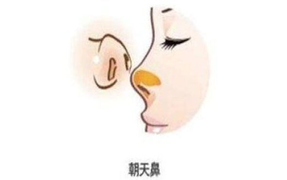 朝天鼻矫正有风险吗？会有后遗症吗？