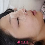 重庆军美医疗整形美容鼻部综合手术术后恢复情况分享