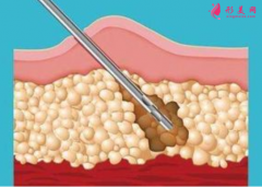 腰腹部吸脂后要按摩吗？