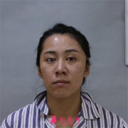 长沙亚韩美容整形医院祛眼袋术后恢复效果反馈