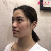 杭州吉奥医疗美容诊所光子嫩肤恢复情况反馈