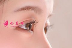 切开双眼皮大约多少钱？