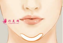 假体垫下巴大约多少钱？