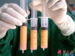 自体脂肪填充脸部要注意哪些风险？