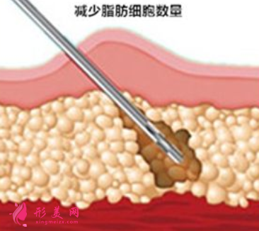 腰腹部吸脂需要多长时间消肿