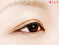 切开双眼皮多少天拆线比较好？