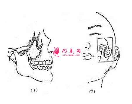 颧弓骨凹陷改善的方法~给你一个漂亮脸蛋！