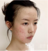 北京丽都医疗美容医院价格表，附激光祛痘案例