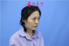 济南海峡美容整形医院鼻综合术后恢复情况对比图分享