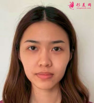 厦门安黛美医疗整形美容自体脂肪面填案例