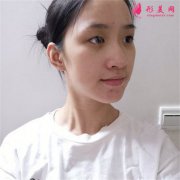 北京彤美医疗美容医院小仙女全切双眼皮术后恢复效果分享