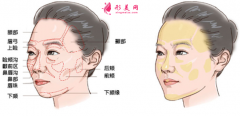 自体脂肪填充面部大约多少钱？