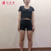 重庆军美医疗整形水动力吸脂瘦大腿恢复情况分享